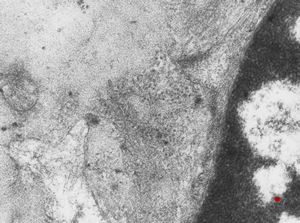 F,40y. | fibrillary glomerulopathy (amyloid negative) F,40y. | fibrillary glomerulopathy (amyloid negative)